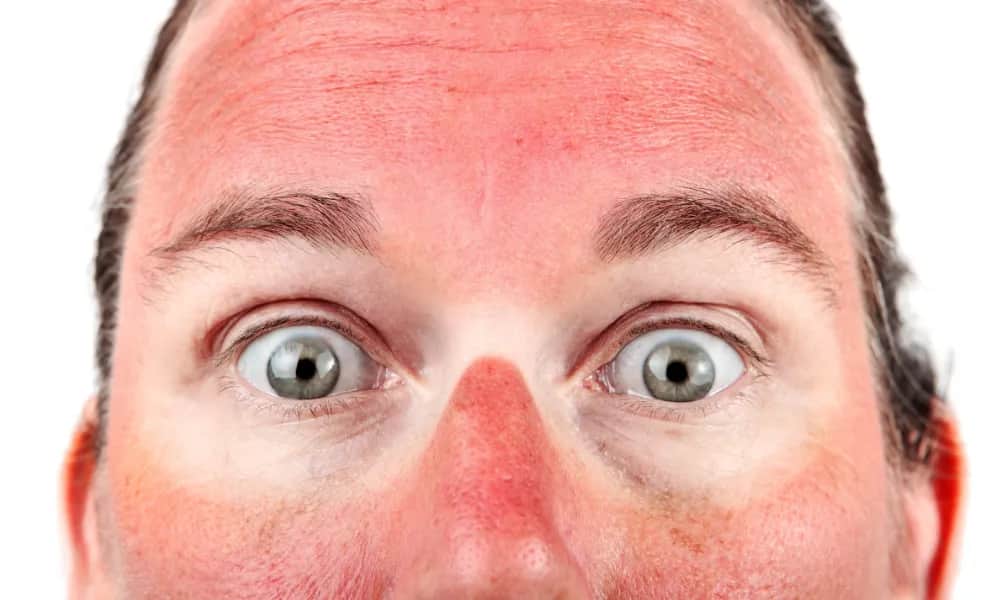 Cera naczynkowa: Jak pozbyć się rumienia i pajączków?