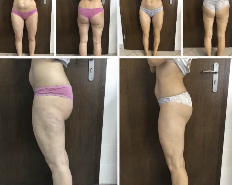 Endermologia: Czym jest? Jak działa? Efekty i wskazania