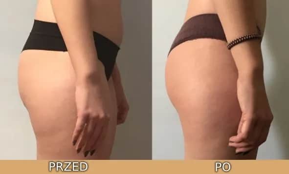 Drenaż limfatyczny: kiedy efekty? Sprawdź, czego się spodziewać!