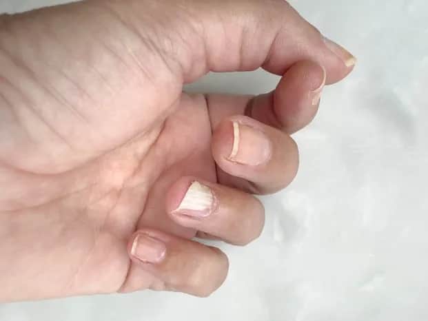 Łożysko paznokcia odrasta? Sprawdź, jak długo trwa regeneracja