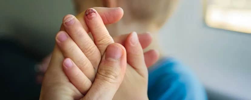 Naderwany paznokieć: szybka pomoc, czego unikać i jak leczyć