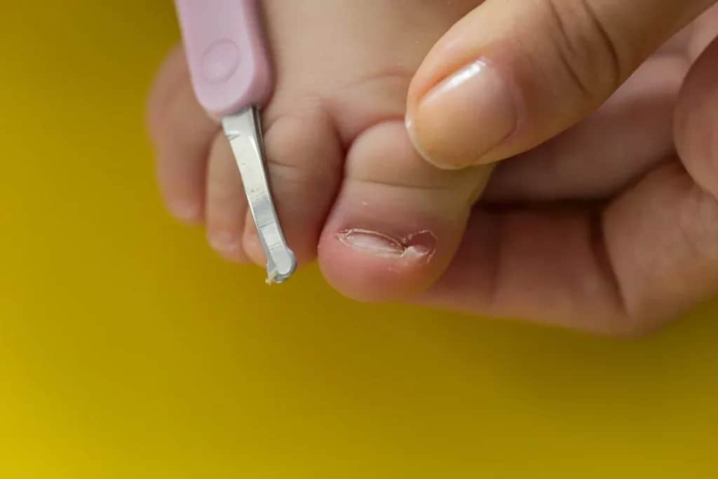 Wrastający paznokieć: Jak usunąć? Domowe i profesjonalne metody