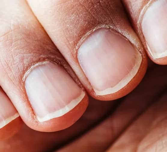 Pofalowane paznokcie: przyczyny, leczenie i domowe sposoby